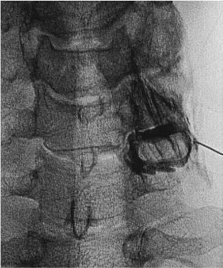 Fluoroscopically Guided Infiltration of the Cervical Nerve Root injection technique with a dorsal approach or modified dorsal direct approach (1,17,18).