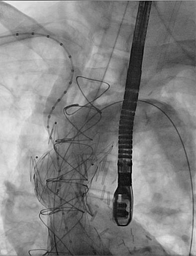 TEVAR for Ascending Aorta: Technical Considerations Hemodynamics, aortic regurg, coronary anatomy including CABG Access evaluation, transapical?