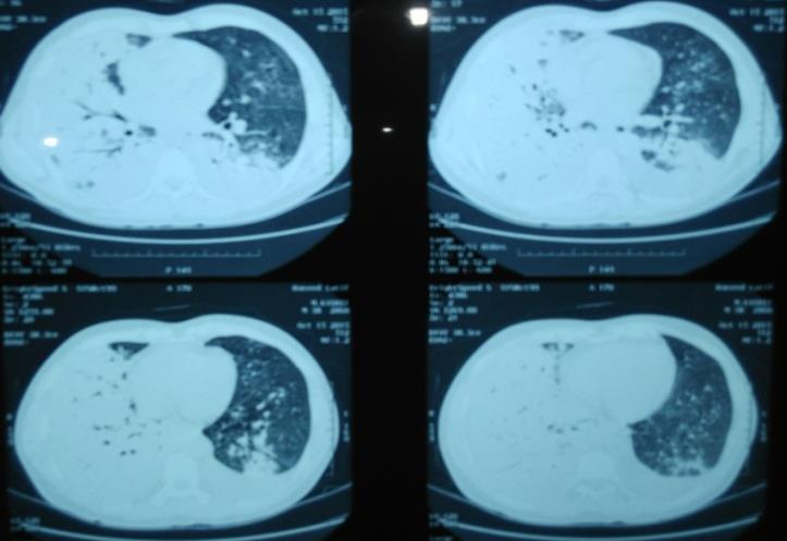 Small volume mediastinal adenopathy and small left sided pleural effusion is also seen.