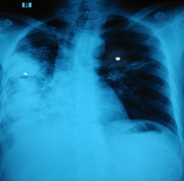 His follow up chest radiograph (Fig. 3) after 2 weeks of discharge from hospital had considerable improvement on both sides.
