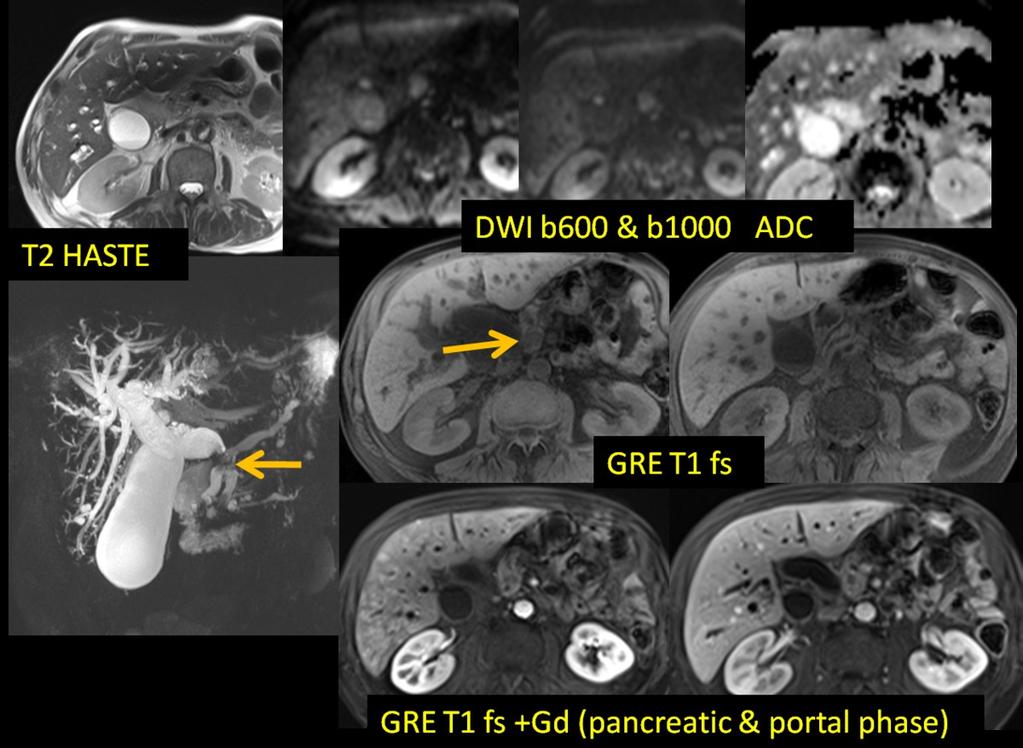 Fig. 2: 70-y-old man with pancreatic adenocarcinoma. Upper row: old examination, chronic calcifying pancreatitis.