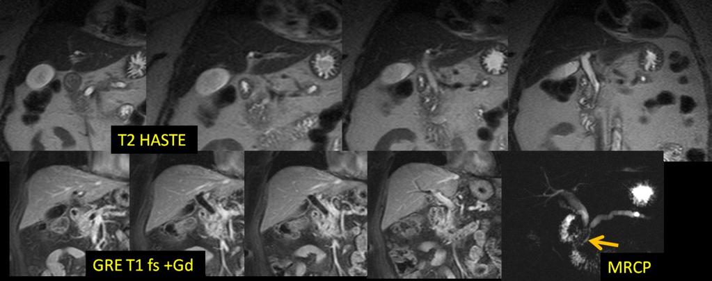 Fig. 8: 61-y-old man with groove pancreatitis (more chronic form).