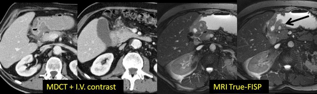Fig. 10: 64-y-old man with groove pancreatitis and cystic dystrophy of the duodenum.