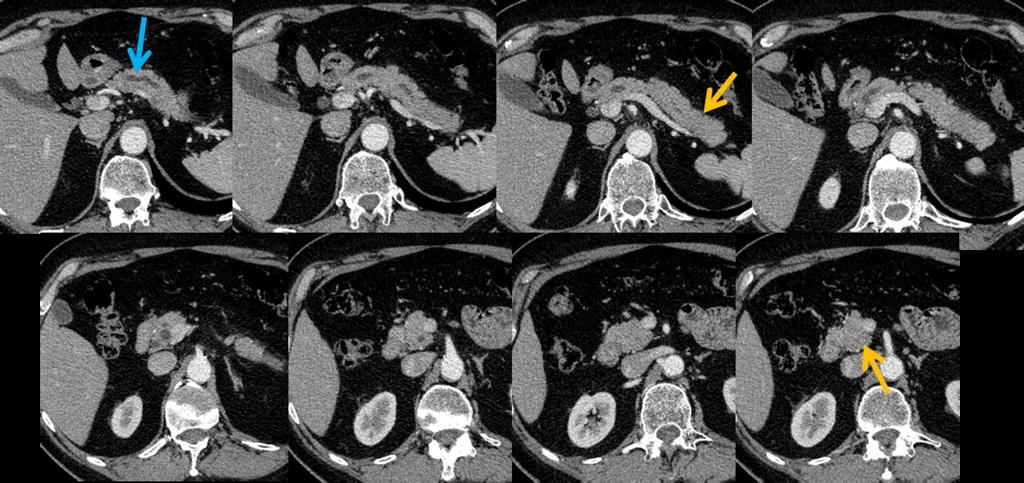 Fig. 12: 61-y-old man with multifocal autoimmune (IgG4-related) pancreatitis (tail and head). MDCT pancreatic phase: slightly swollen pancreatic head and tail (yellow arrows).