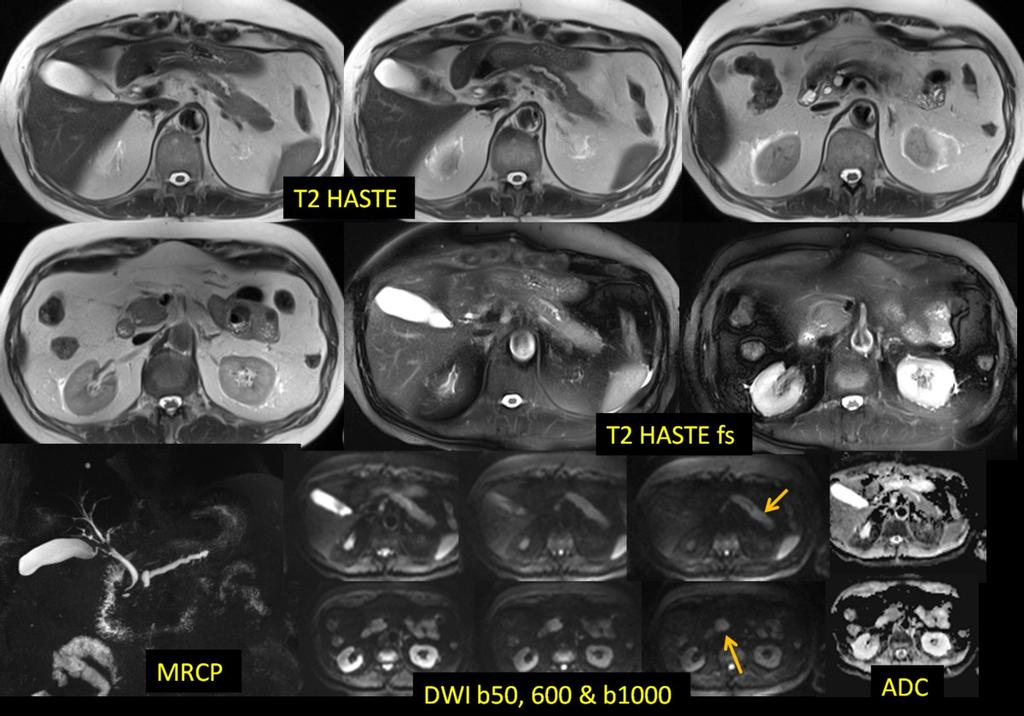 Fig. 13: 61-y-old man with multifocal autoimmune (IgG4-related) pancreatitis (tail and head), same patient as Fig.12.