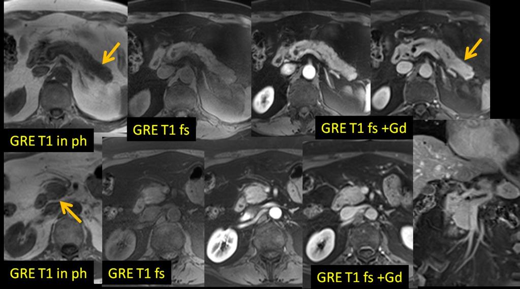 Fig. 14: 61-y-old man with multifocal autoimmune (IgG4-related) pancreatitis (tail and head), same patient as Fig.12&13. MRI: slightly swollen pancreatic head and tail.