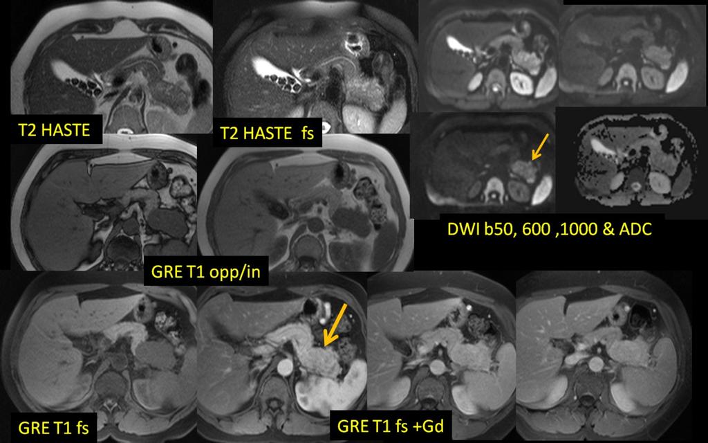 Fig. 16: 50-y-old man with a Neuro-Endocrine-Tumour.