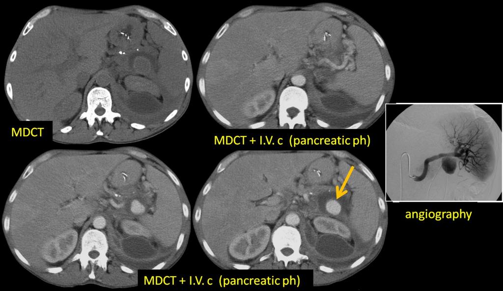 Fig. 18: 63-y-old man with a pseudoaneurysm of the splenic artery. MDCT.