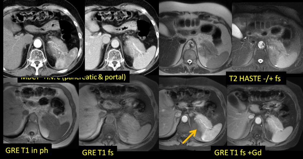 Note same signal and contrast behaviour of the pseudoaneurysm as the aorta. Fig.