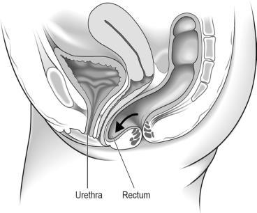 c) Back (posterior prolapse) d) Uterine prolapse e) Vaginal apex/vault prolapse (following hysterectomy) c) d) e) *Reproduced with permission from the Royal College of Obstetricians and