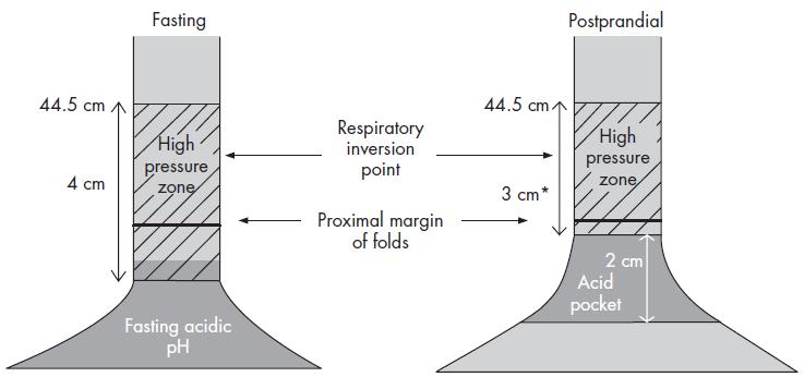 Location of the acid pocket in fasting and post prandial conditions in healthy subjects.