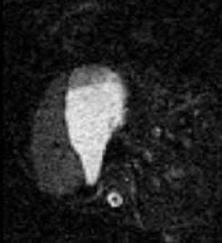 Layering of unbuffered acid in proximal stomach MRI scan Following meal proximal