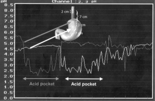 7 Preventing formation of the acid pocket Inhibit postprandial acid secretion with PPI