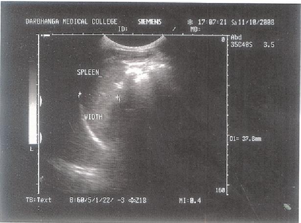 Showing width of the spleen (Female) Table- II : Comparison of the spleen width with the height in the females Height [cm] No. Mean (mm) ±?S.D. Range (mm) 146-150 14 41.41 ± 9.85 31.4-69.8 Fig.