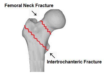 2. THEORETICAL BACKGROUND 19 2.2.2. Hip Fracture and Fracture Types Hip fractures are defined as bone fractures at anywhere from the articular cartilage of the hip joint to 5cm below the distal point