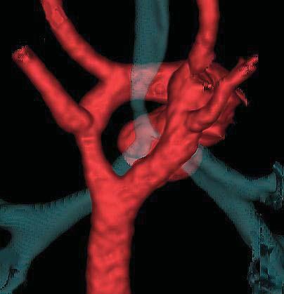 DOUBLE AORTIC