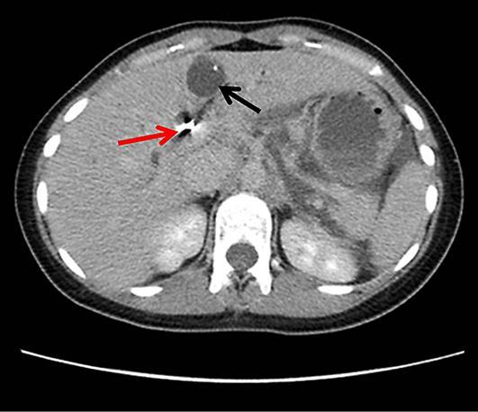 11 Fig. 1. CT scan showing biliary cystadenoma.