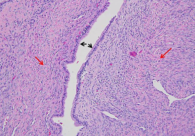 12 Fig. 3. Histology of biliary cystadenoma: high power view (20 ) showing mucinous lining of the cyst (black arrows) along with the ovarian like stroma (red arrows).