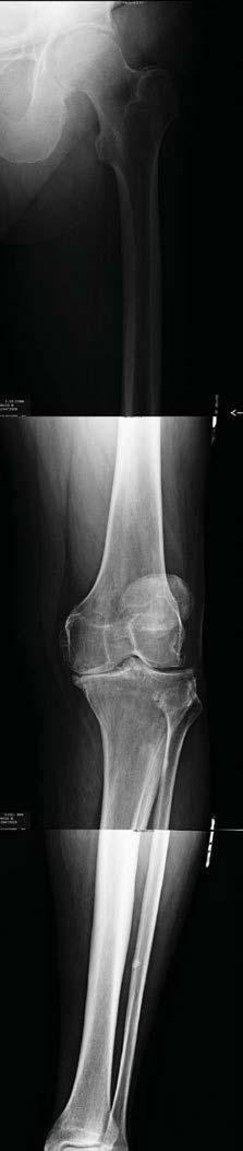 Quality X-Rays are imperative to the VISIONAIRE process. Rotation in the full leg X-Ray can alter the measured mechanical axis of a patient.