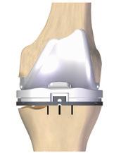 Surgical Procedure Using the Tibial Augment / Straight Stem with U2 CMA