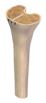 Drill until reaching to the marked depth according to desired size of tibial