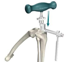 Triathlon Knee System Universal Baseplate Surgical Protocol > Attach the T-Handle Driver to the 5/16 IM Rod and slowly pass into the canal, ensuring clearance.