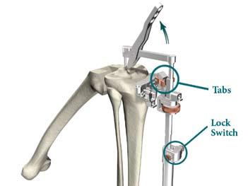 Triathlon Knee System Universal Baseplate Surgical Protocol Figure 10 > Remove all alignment instruments leaving only the Revision Tibial Resection Guide in place.