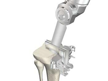 Instrument Bar 6543-2-70 Tibial Sagittal Resection Guide Figure 12 Tibial Preparation > If an additional 10mm tibial augment resection is required, remove the X pin and drop the resection guide down