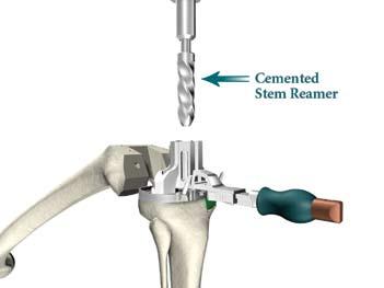 Triathlon Knee System Universal Baseplate Surgical Protocol > Attach the appropriate Cemented Stem Reamer to the Universal Driver.