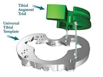 Universal Tibial Template, Tibial Augment Trial, Alignment Handle and PS or CR Tibial Insert Trial Assembly: > Line up the pins of the Tibial Augment Trial with the
