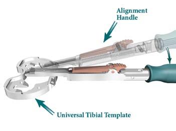 Insert the spring-loaded tip of the Alignment Handle into the central posterior hole of the Universal Tibial Template.