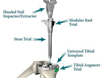 Modular Keel Trial, Stem Trial, Tibial Augment Trial, and Universal Tibial Template Assembly: > Line up the pins of the Tibial Augment Trial with the holes on the corresponding sized Universal Tibial