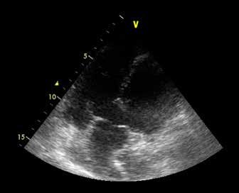 272 Sarnecka, et al. Figure 1. Transthoracic echocardiography showed ventricular septal defect, overriding aorta with biventricular connection and dilated ascending aorta Figure 3.