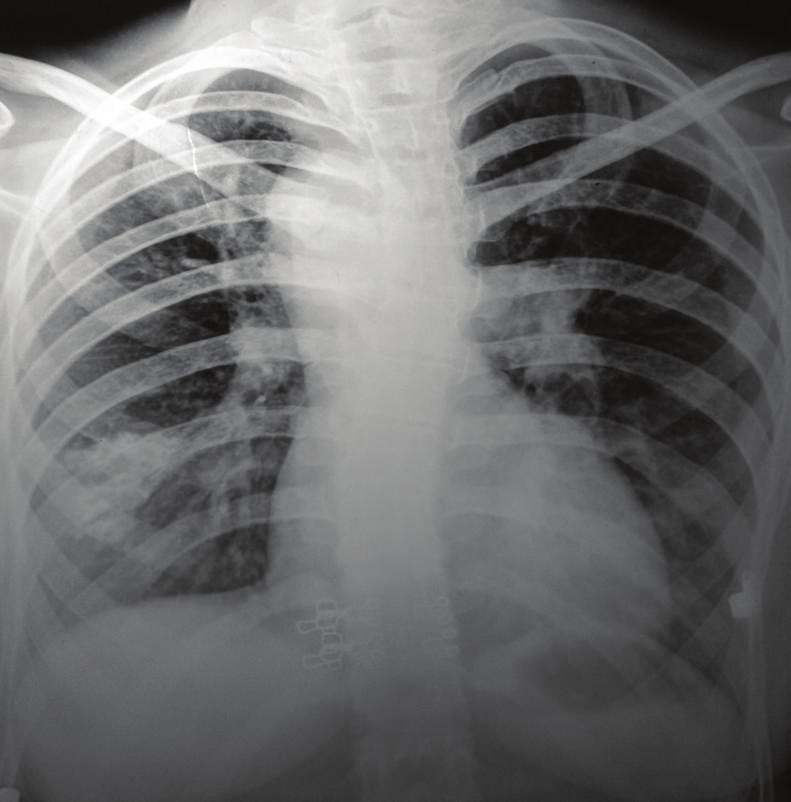 2 Case Reports in Radiology Figure 1: Chest radiograph: frontal view reveals left hilar prominence, right sided aortic arch (arrowheads), absent pulmonary conus (thick arrow), and a small ill-defined