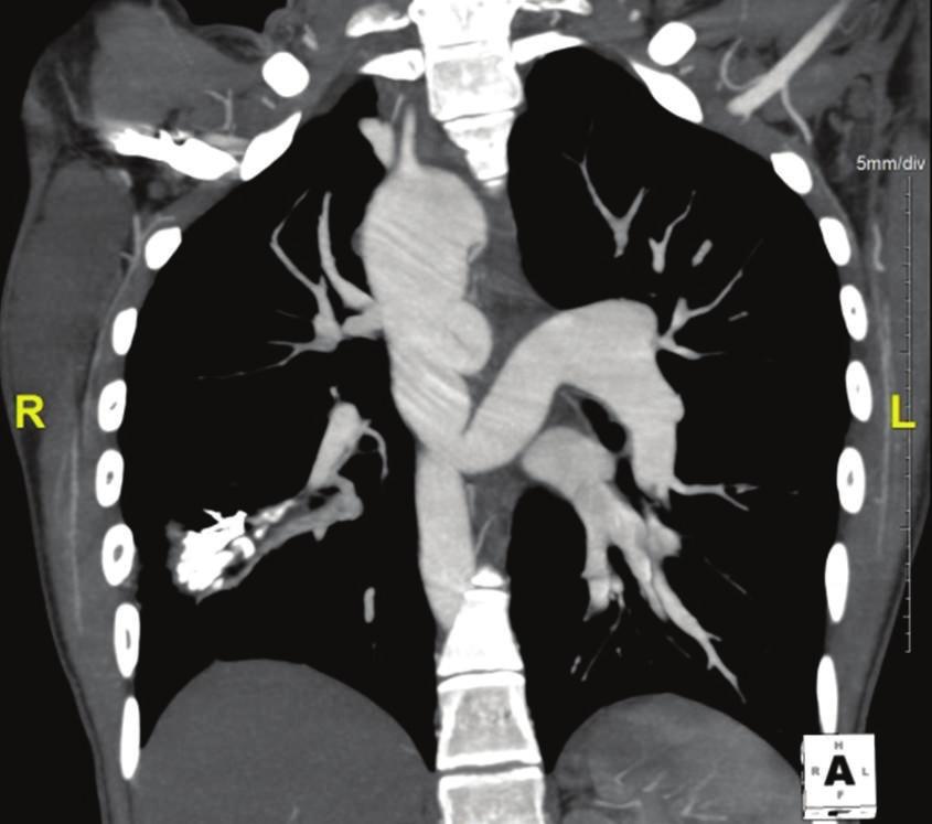 right sided aortic arch with large arterial channels arising from the left