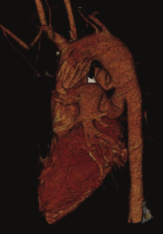 lung with a vascular pedicle (arrow head).