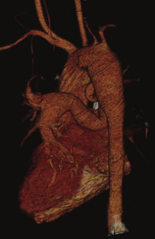with overriding of the aorta (thick arrow).