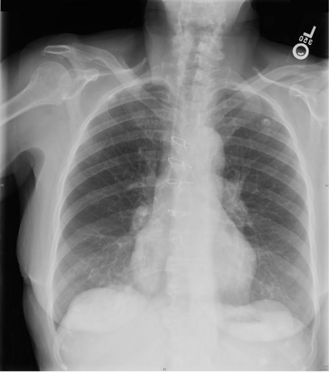 Our Patient: CXR with RLL
