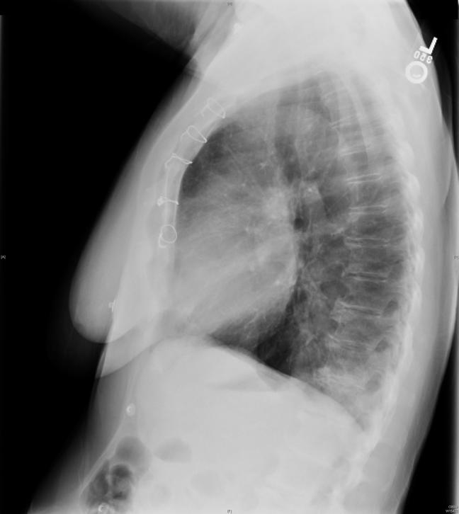 chest X-ray read as RLL opacity