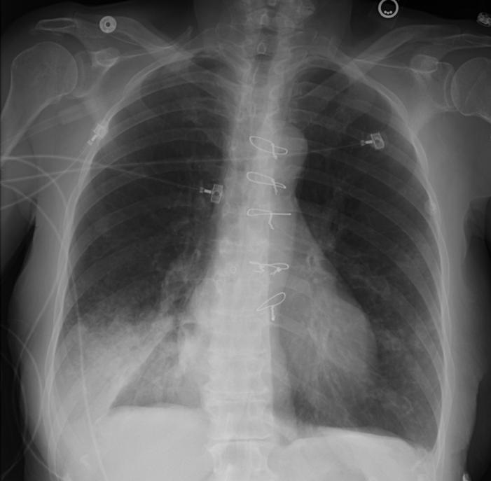 Our Patient: Comparing Aerated Lung