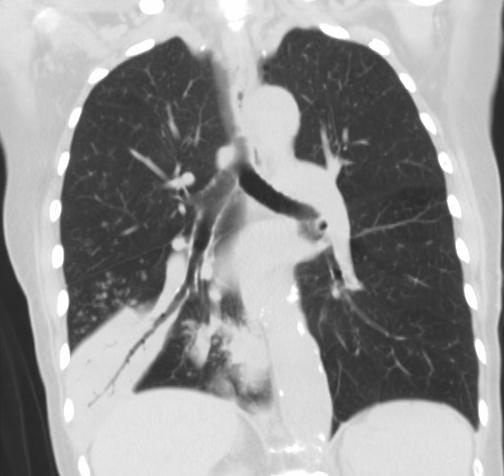 (lung window) at presentation Supine AP