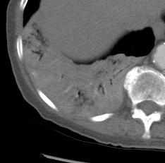 Our Patient: Consolidative (Pneumonic) BAC Filling of the airspace with mucus Low-attenuation consolidation on CT due to mucin content Air bronchograms CT angiogram sign on C+ images: