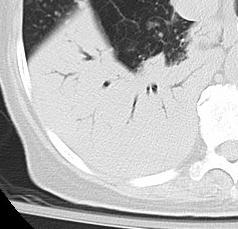 Our Patient: Consolidative BAC CT changes of the airfilled bronchus in a consolidation that favor BAC to PNA: Stretching Squeezing Sweeping Widening