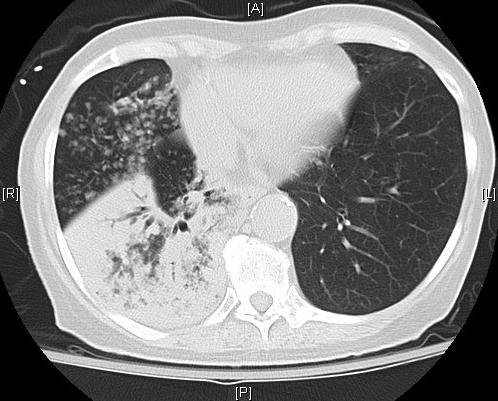 Our Patient: CT after 4 Cycles of Chemotherapy Fewer nodules and