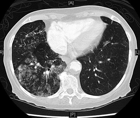 in RLL Axial C- Chest CT (lung window), at presentation From PACS,