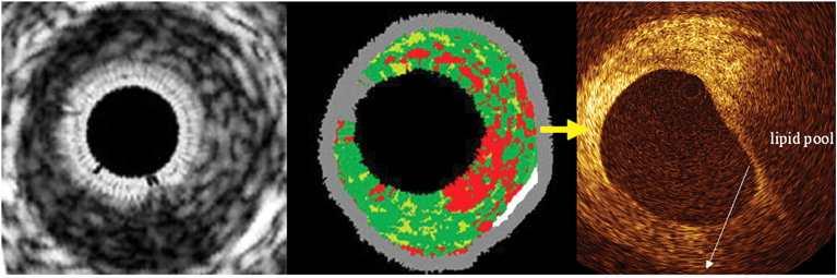 Use of VH-IVUS vs OCT for detecting