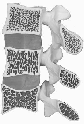Of the three vertebrae, one is normal, one has lost some bone density, the third has a severe loss of bone density.