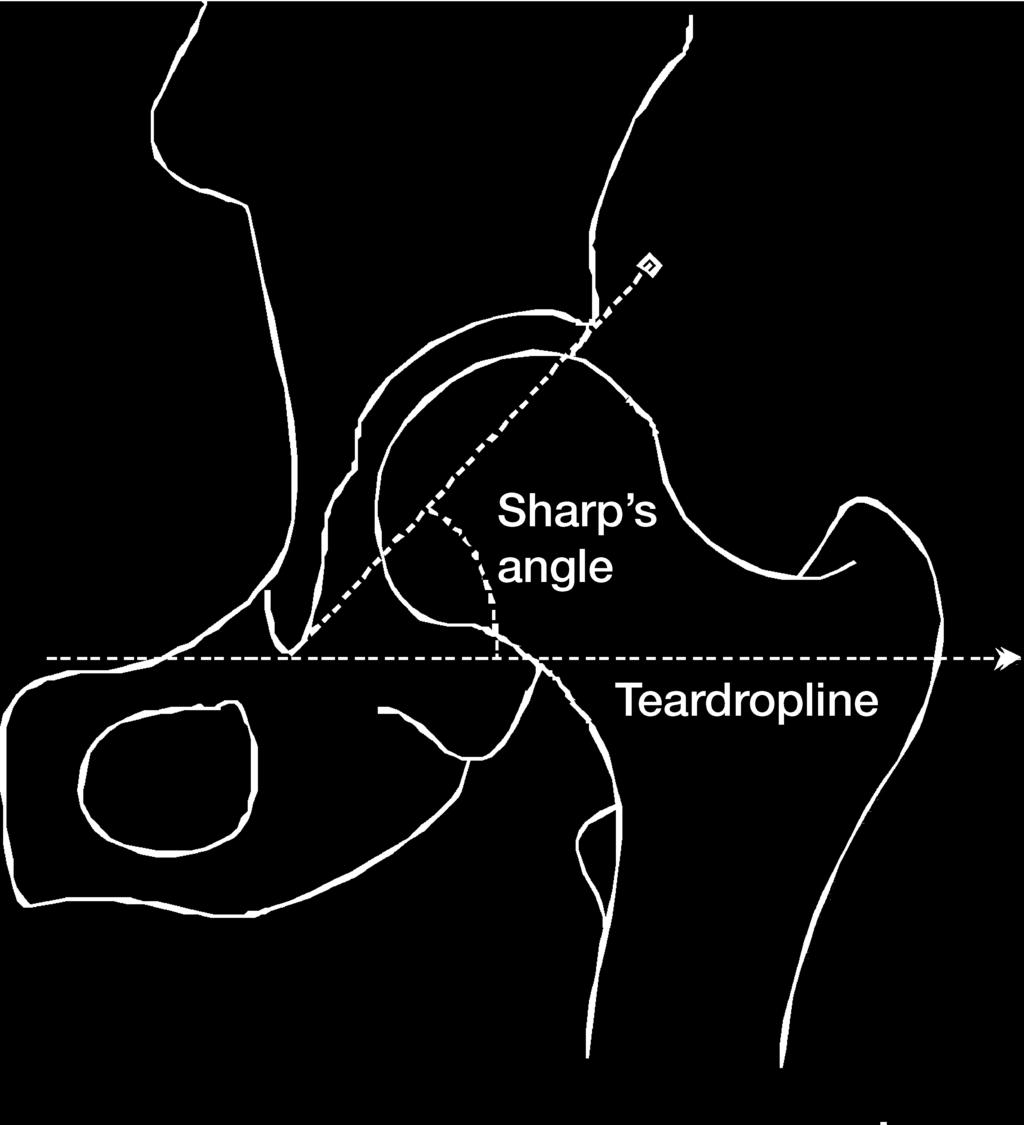 The transverse plane was defined by trial radiographs with horizontal alignment of the teardrop line.