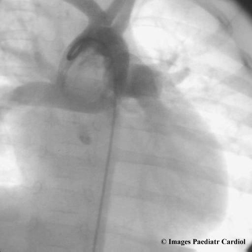 was obtained. Ascending aortography demonstrated a 5mm aortopulmonary window (Fig. 2,3).