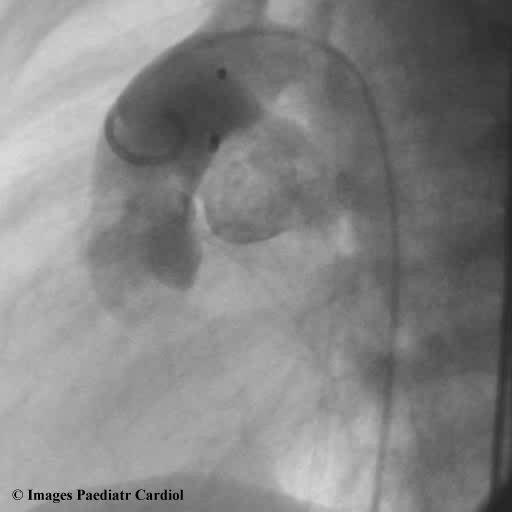 Figure 5 As figure 4 in lateral projection. Discussion Aortopulmonary window is a rare congenital heart defect occurring in 0.1-0.2% of patients with congenital heart disease.